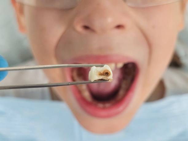 Best Emergency Tooth Extraction in Martinsville, NJ